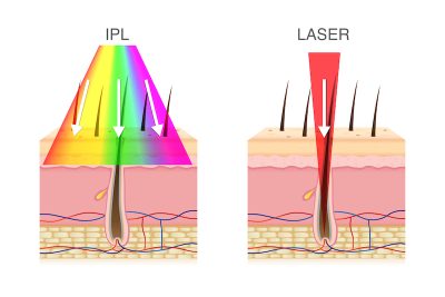 Depilação a laser e depilação por luz pulsada