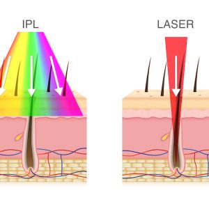 Depilación láser y depilación IPL